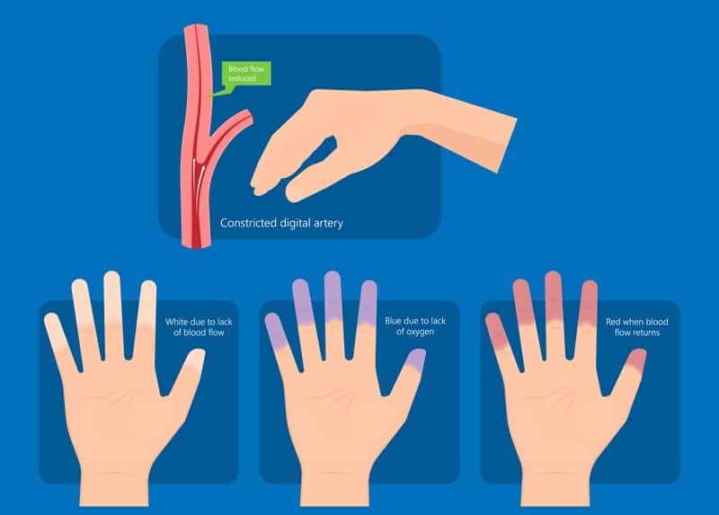 inszeniert kalte Hände Raynauds Symptom